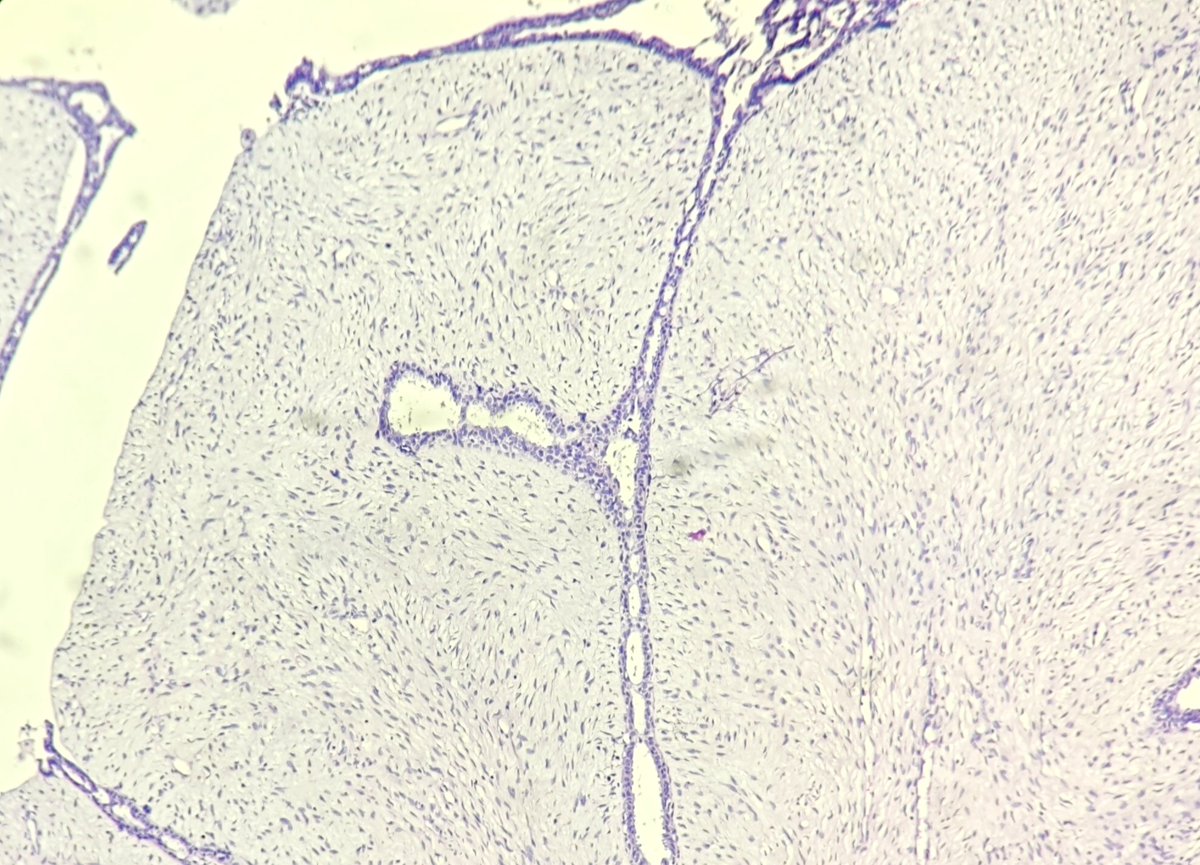 Leafy clefts of benign phyllodes tumor can be eye candy. #pathology #breastpath #benign_phyllodes