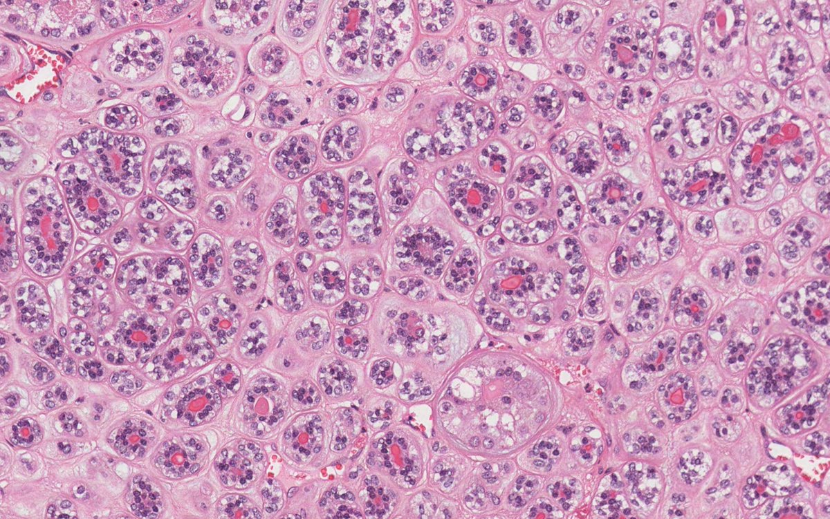 70M with parotid mass. What is your diagnosis? 
#oralpath #oralpathology #pathology #pathologists #pathTwitter #HeadNeckPathol #HeadandNeckPath #ENTPath #PathologyTweet