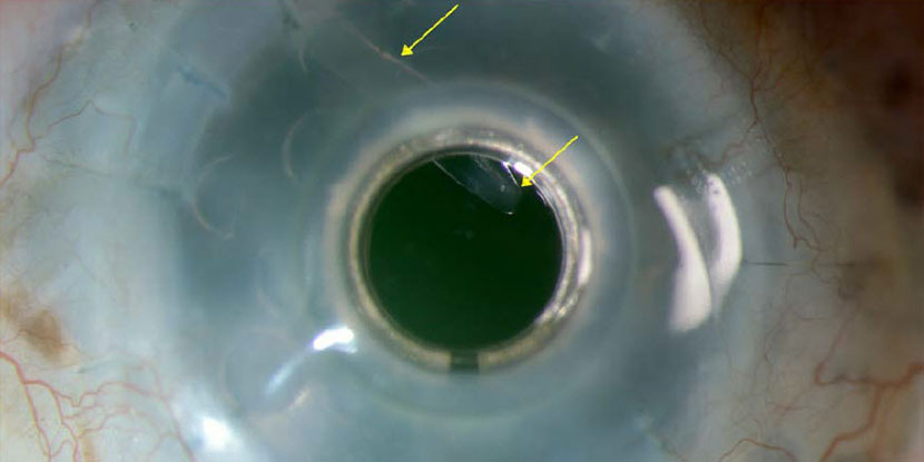 A #glaucoma valve appears to provide good IOP control in patients with an artificial corneal implant.
ow.ly/jWaO50WCaGc
#AAO #Ophthalmology #cornea