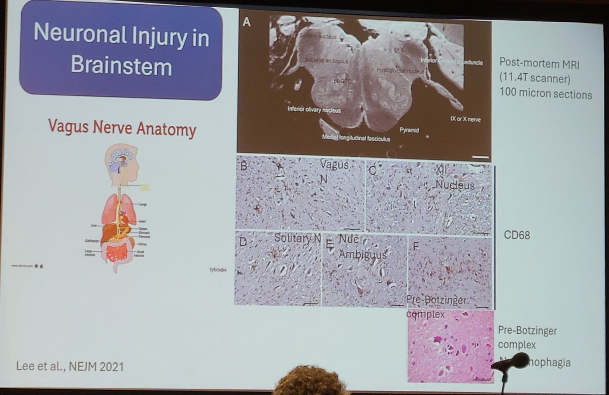Dr. Jennifer Curtin (@jencurtinmd) on Twitter photo Here are 📸 of some slides from Dr. Nath's lecture on the neurological complications of #LongCOVID & #MECFS at #KSlongcovid25 #KeystoneSymposia. Taken & shared with permission from <a href="/nathavindra/">Avi Nath</a>! <a href="/loscharlos/">charlos</a> <a href="/ahandvanish/">Hannah Davis</a> <a href="/MEActNet/">#MEAction Network</a> <a href="/OpenMedF/">Open Medicine Foundation</a> #pwLC #pwME <a href="/bhanlon15/">Billy Hanlon</a> @rthm_health🧵/1 Here are 📸 of some slides from Dr. Nath's lecture on the neurological complications of #LongCOVID & #MECFS at #KSlongcovid25 #KeystoneSymposia. Taken & shared with permission from <a href="/nathavindra/">Avi Nath</a>! <a href="/loscharlos/">charlos</a> <a href="/ahandvanish/">Hannah Davis</a> <a href="/MEActNet/">#MEAction Network</a> <a href="/OpenMedF/">Open Medicine Foundation</a> #pwLC #pwME <a href="/bhanlon15/">Billy Hanlon</a> @rthm_health🧵/1