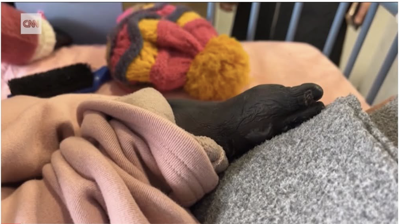 RafeefGarbi's tweet image. The Israeli army destroyed Gaza's hospitals, slaughtered 🇵🇸 doctors, denied entry to medication and foreign medical aid, refused to let Habiba be evacuated until this happened to her limbs. Can you imagine watching your child suffer like this? This is the Zionism of @MarkJCarney.