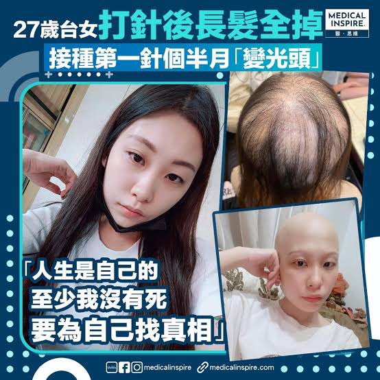 台湾一名女子接种 Moderna Covid-19 疫苗后…
27岁台湾女公民琪琪，日前接受YouTube频道“不再沉默 无畏声音解除静音频道”采访，表示自己于2022年1月7日接种第一针 #摩德纳疫苗，岂料接种后2、3周，就开始疯狂掉发，每次洗头、吹头发，头发就一根一根地掉，原本一个半月后头发就全部掉光，让她成了秃头