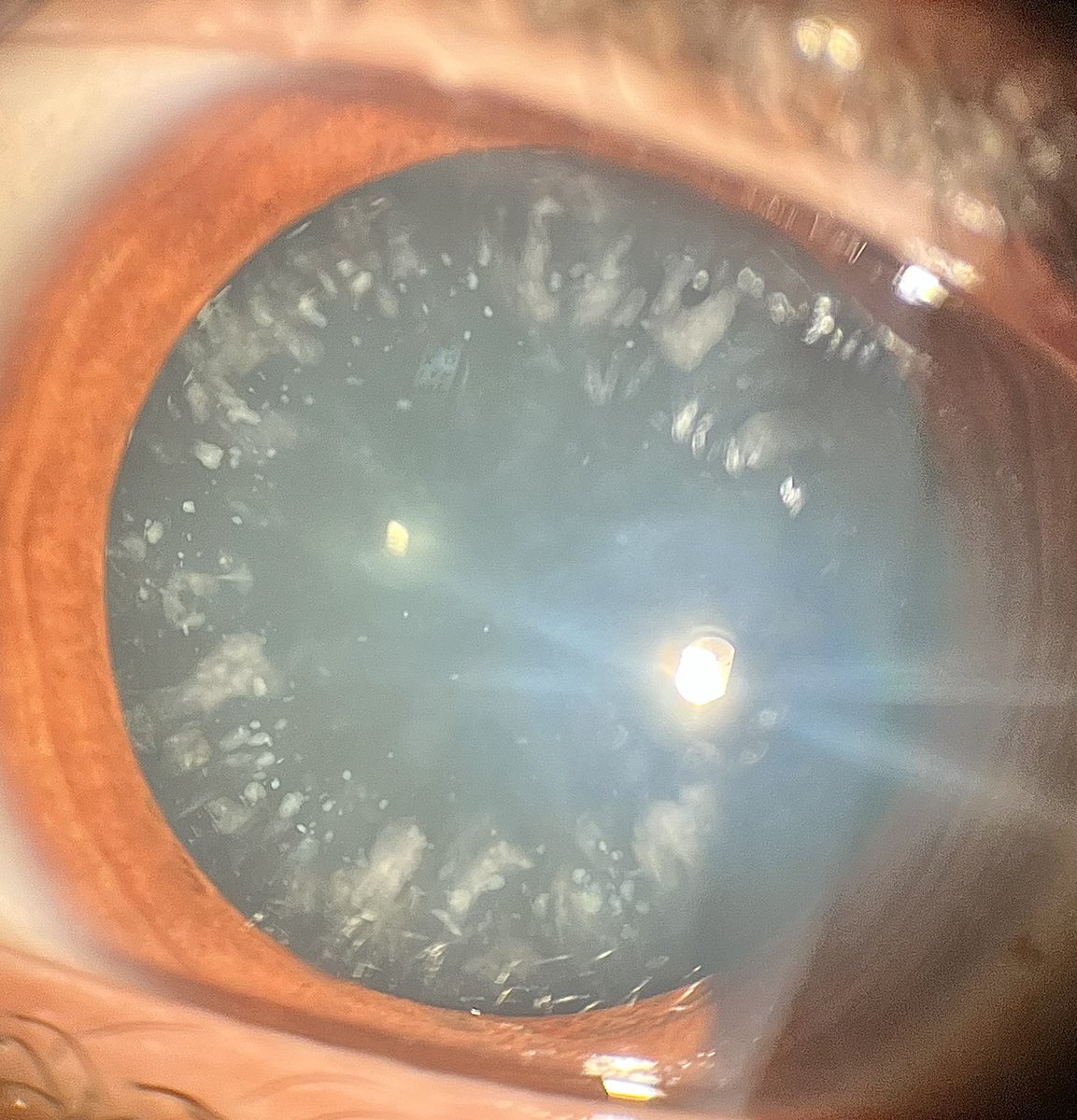 🔵 Blue Dot Cataract:

1️⃣ Common in kids 👶

2️⃣ Tiny bluish opacities ✨

3️⃣ Stable, non-progressive 🛑

4️⃣ Usually asymptomatic 👀

5️⃣ Surgery rarely needed 🔪❌

👉 Often just an incidental finding!

#Ophthalmology #medtwittter