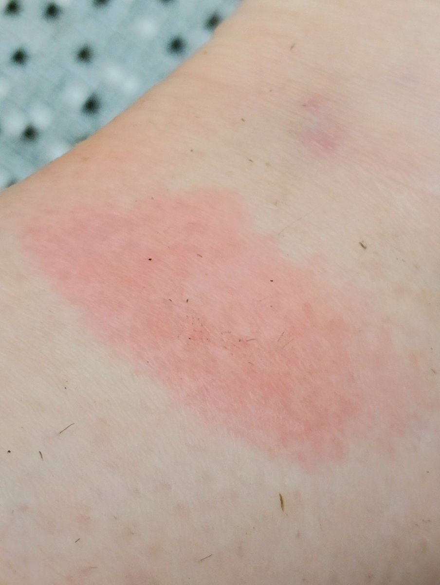 Bitte nicht, ich habe keine Lust auf eine erneute Antibiotikadröhnung

Da ich aber so oft Zecken an mir habe, war das nur eine Frage der Zeit 

Morgen früh erstmal zum Hausarzt