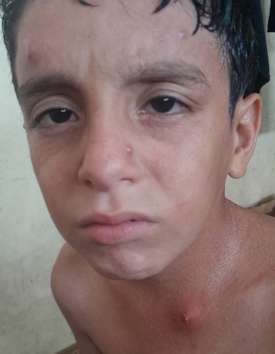 RozeatG's tweet photo. My poor son Adam has a skin rash due to water pollution and a lack of cleaning supplies. He needs treatment and cleaning supplies. Please donate and save my son. He is also in severe pain. Please help me.🙏🙏🙏
https://t.co/1BtK9tMvJu https://t.co/x3etmSzVpc