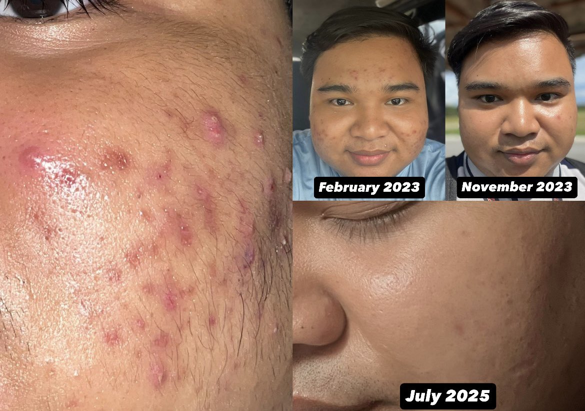 Basic skincare is not enough for me. I start introduce this serum in my routine baru lah skin barrier I cepat pulih. Jerawat pun cepat kecut.

Btw sunscreen I buang jauh2 time breakout (pharmacist suruh stop).