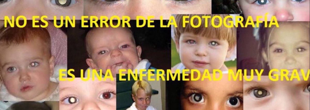 NoInvisibles's tweet photo. Es día de la #EnfermedadDeCoats o Síndrome de Retinitis Exudativa #DíaInternacionalDeLaEnfermedadDeCoats
Produce pérdida progresiva de la visión, comienza en la niñez y se desarrolla de forma lenta y continua.
El oftalmólogo 🇬🇧 George #Coats, describió en 1908 esta enfermedad crónica idiopática de la retina.
Atentos a los puntos blancos unilaterales en las fotos‼️👁️
Dan una alerta temprana 🧐
Más investigación‼️
Info @CoatsAfece👇@micofvlc 
https://t.co/W0Zue95J1u