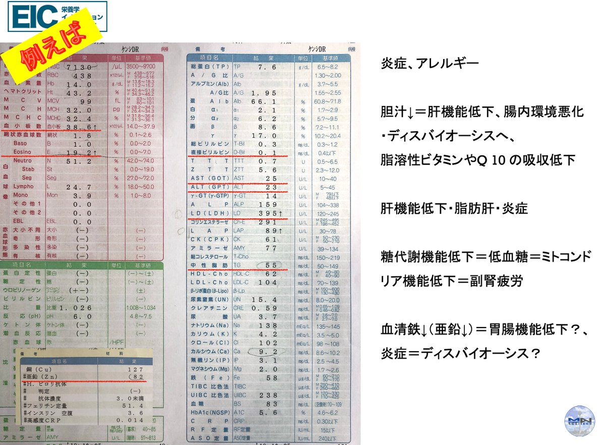 kikurin2017's tweet photo. この方の検査データを見ると、炎症や肝機能の軽度の低下、胆汁分泌の不足、糖代謝の乱れ、亜鉛不足といったサインが見えています。これらは単発の問題というよりも、「代謝・解毒・炎症コントロール」の全体的なネットワークが弱っていることを示唆します。

1. 炎症・アレルギー傾向

好酸球（Eosino）が 高い（19%）
→ アレルギーや慢性炎症（花粉症、喘息、皮膚炎、腸炎など）を示唆。
→ ポリヴェーガル理論的にも、慢性的な交感神経優位やヒスタミン過剰が関わる可能性。

CRPは軽度上昇はないが、白血球分画のバランスで「炎症のくすぶり」が見える。

👉 こういう背景では「ヒスタミン過剰症（かゆみ、蕁麻疹、IBSなど）」が出やすい。

2. 肝機能・胆汁分泌
γ-GTP 23、ALT（GPT）23 → 基準値内だが「胆汁うっ滞ぎみ」

亜鉛低め（82 μg/dL） → 胆汁酸の代謝やアルコール分解、膵酵素にも影響。

胆汁が減ると
腸内での脂質消化が不十分 → 脂溶性ビタミン（A, D, E, K, CoQ10）の吸収低下

腸内環境悪化（ディスバイオーシス） → 腹部膨満、便秘/下痢

👉 中医学的には「肝胆の疏泄不利」、長野式なら「胆虚」サイン。

3. 糖代謝・副腎疲労
空腹時血糖 92、HbA1c 5.6 → 一見正常

ただし「低血糖傾向」あり。AST・ALTのバランス、亜鉛不足からもインスリン分泌や糖利用が不安定。
→ ミトコンドリアが効率よくATPを作れていない可能性。
→ 副腎疲労（コルチゾール低下）に繋がりやすい。

👉 臨床でよく見る「午後のだるさ、コーヒーや甘い物が欲しくなる」タイプ。

4. ミネラルバランス
銅 127 μg/dL（やや高め）

亜鉛 82 μg/dL（低め）
Cu/Zn比が 1.5以上 → これは炎症や免疫異常、うつ症状との関連が知られている。

👉 亜鉛不足は
胃酸分泌低下 → タンパク質消化不良

味覚・嗅覚低下

皮膚トラブル、精子形成不全

精神面では「不安感や集中力低下」にもつながる。

5. 代謝のボトルネック（まとめ）
胆汁↓ → 腸内環境悪化・脂溶性栄養素不足
亜鉛不足 → 胃腸機能低下・免疫バランス乱れ

低血糖傾向 → ミトコンドリア疲弊・副腎疲労

好酸球↑ → アレルギー体質・慢性炎症
全てがつながっていて、「消化吸収・解毒・代謝・免疫」ネットワークが負担状態といえます。

改善の方向性
亜鉛・マグネシウム・ビタミンB群の補給
→ 胃酸や膵酵素をサポートし、糖・脂質・タンパク質代謝を改善。

ビタミンC＋フラボノイド（ケルセチン）
→ ヒスタミン過剰や炎症抑制、副腎サポート。
（まさに「ケルシー」や「セルジネイトC」が理にかなう）

脂溶性ビタミンとCoQ10
→ 胆汁分泌低下を補うように意識して摂取。
特にビタミンDとEは不足しやすい。

腸内環境調整（プロバイオ・プレバイオ、低FODMAP調整）
→ ディスバイオーシスを是正し、炎症を落ち着ける。
（低胃酸があるなら消化酵素をサポート）

副腎の休養（睡眠・ストレスケア・アダプトゲン）
→ コルチゾールの日内リズムを整えることが必須。
鍼灸では「腎虚」ケア、「肝鬱」を流す配穴が有効。
