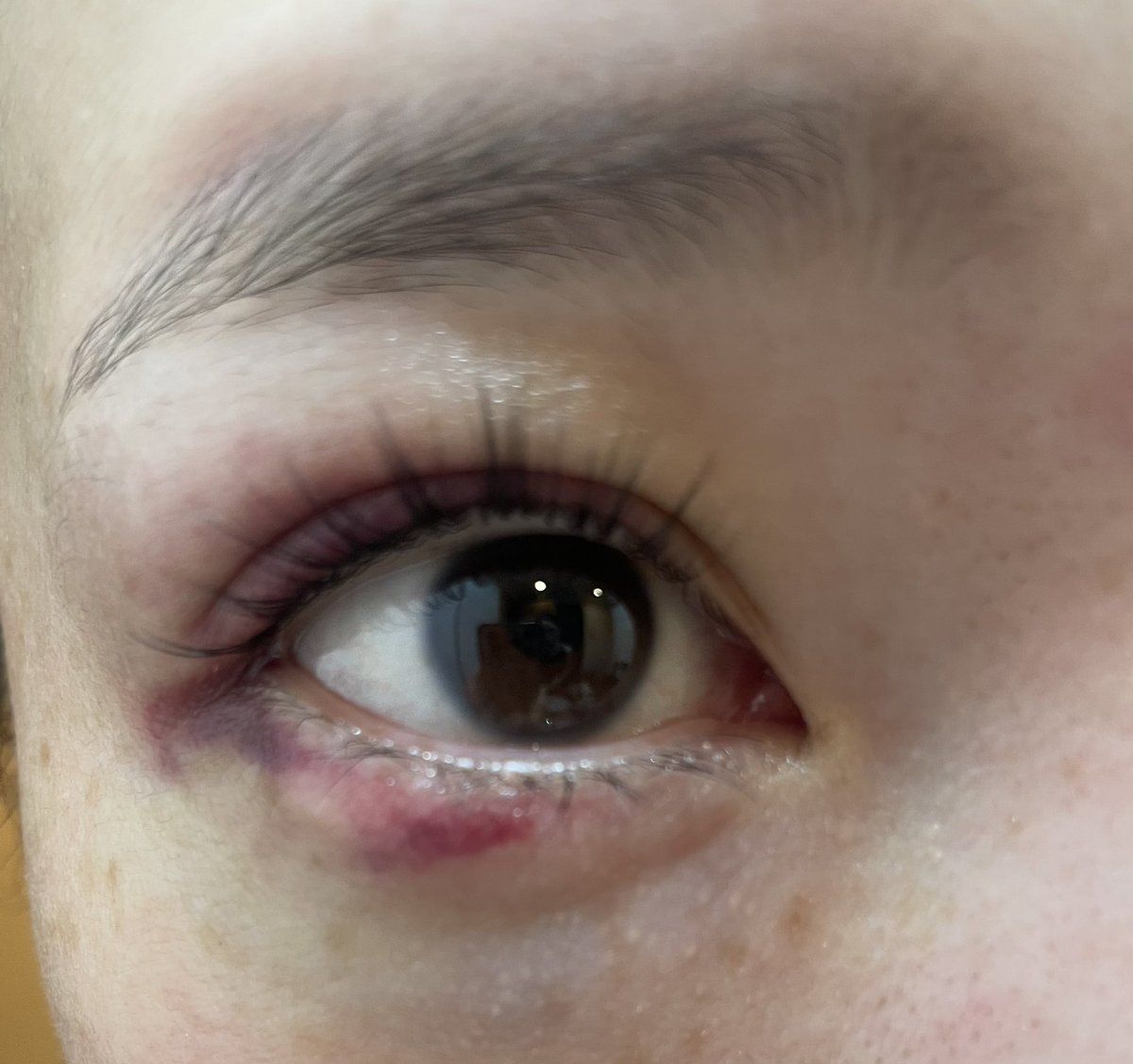 昨日バスケで、顔面怪我してしまったのだけど(私が悪い)化粧でここまで隠せた！化粧ってすげ〜！！！お盆最終日楽しみしたっ！！完！！