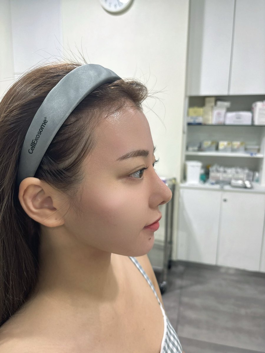 最近前髪伸ばしはじめておでこ出すようになったから額フィラーはじめてしてきた！

丸みはあるけどめちゃくちゃ自然にお願いしたよ♡