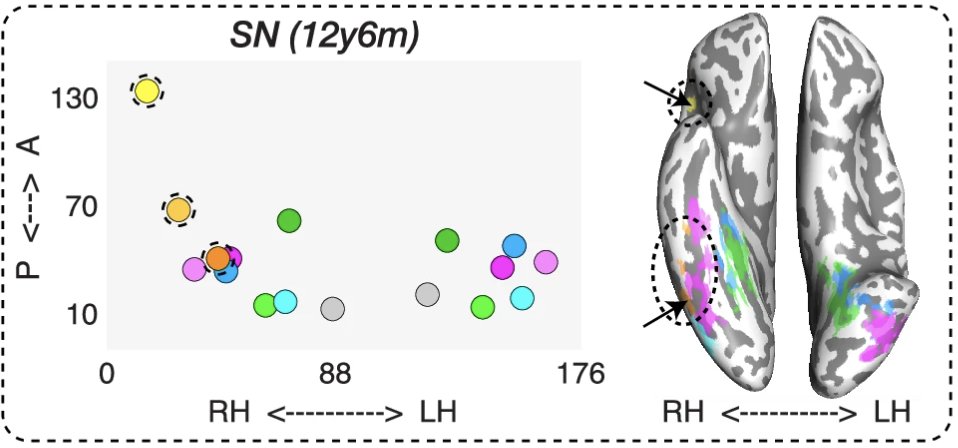 With the above in mind, here are a few highlights from our study:

First, we show in several cases of LEFT pediatric OTC resection that word representations are in fact lateralized to the RIGHT hemisphere, both in right OTC and right language cortex (shaded yellow/orange here).