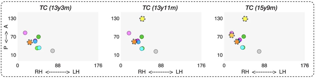 For one patient (TC), we imaged her pre-surgery (at age 13y3m) and twice post-surgery (months and then years after surgery). While we cannot map word representations in superior temporal gyrus (light orange) or inferior frontal gyrus (yellow) PRE-surgery, we can POST-surgery.