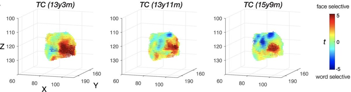 Notably, we see that over time &amp; pre- to post-surgery, voxels in TC's right OTC "switch allegiance" from representing faces to representing words. That is, word representations emerge in RIGHT OTC after LEFT OTC resection, a complete deviation from the standard topography.