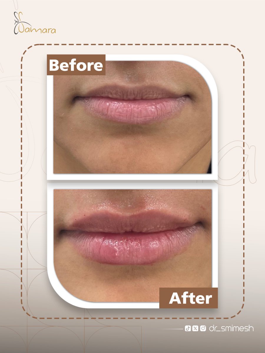 قبل وبعد فيلر الشفايف😘

لأن جمالك يستحق✨️
📍 حي الحمراء - طريق الملك عبدالله
الرياض، المملكة العربية السعودية

📩 للتواصل:
☎️ 920021331
📞 0509334646
📞 0509334747

#واقي_شمس #بشرة_صحية #نضارة_دائمة #dr_smimesh