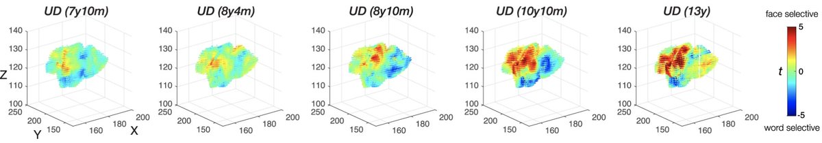 We see a similar pattern in patient UD. UD had a RIGHT OTC resection, and we observe face representations emerging in LEFT OTC, with voxels in his left OTC also "switching allegiance" from words to faces, an extension of <a href="/TinaLiuTong/">Tong (Tina) Liu</a>'s prior work: cell.com/cell-reports/f…