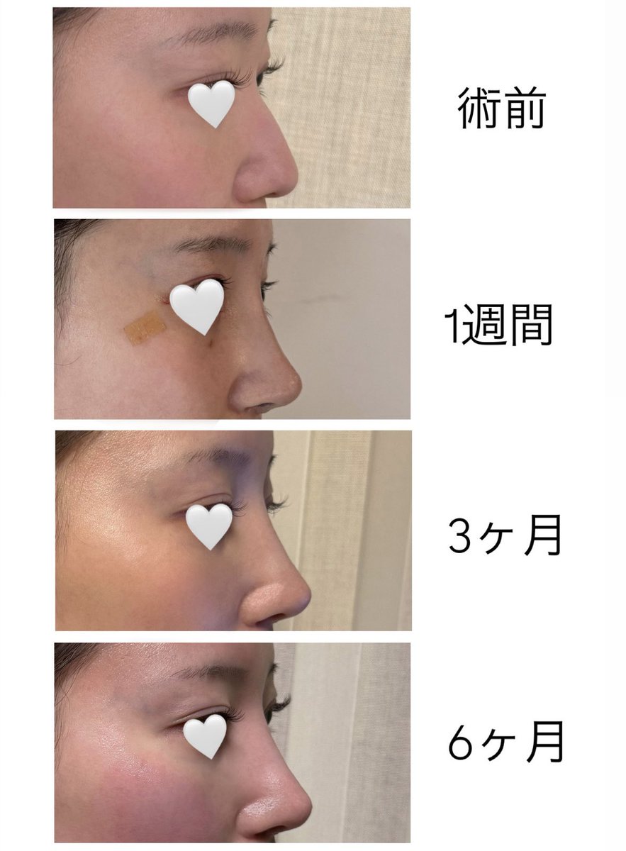 _mixry6's tweet photo. ZESTAR美容外科さん(@zestarps )
鼻フル  【6ヶ月レポ】

🩶執刀医  チェ・ヒョクギュ院長

鼻柱の傷も完全に分からなくなり、鼻根も鼻先も高さが落ち着いて安定しました🙆‍♀️正面は3ヶ月目とほとんど形は変わっていません🙂‍↕️鼻が整ったことですっぴんで出かける日が増えました😼❤️笑(3枚目) https://t.co/iNDK6FBktL