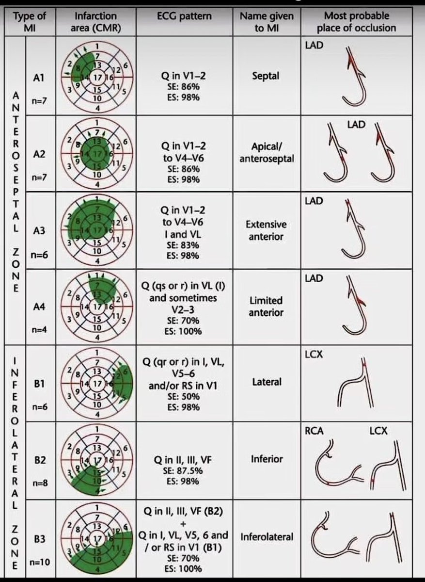 MI Localization Made Easy: ECG + CMR Correlation