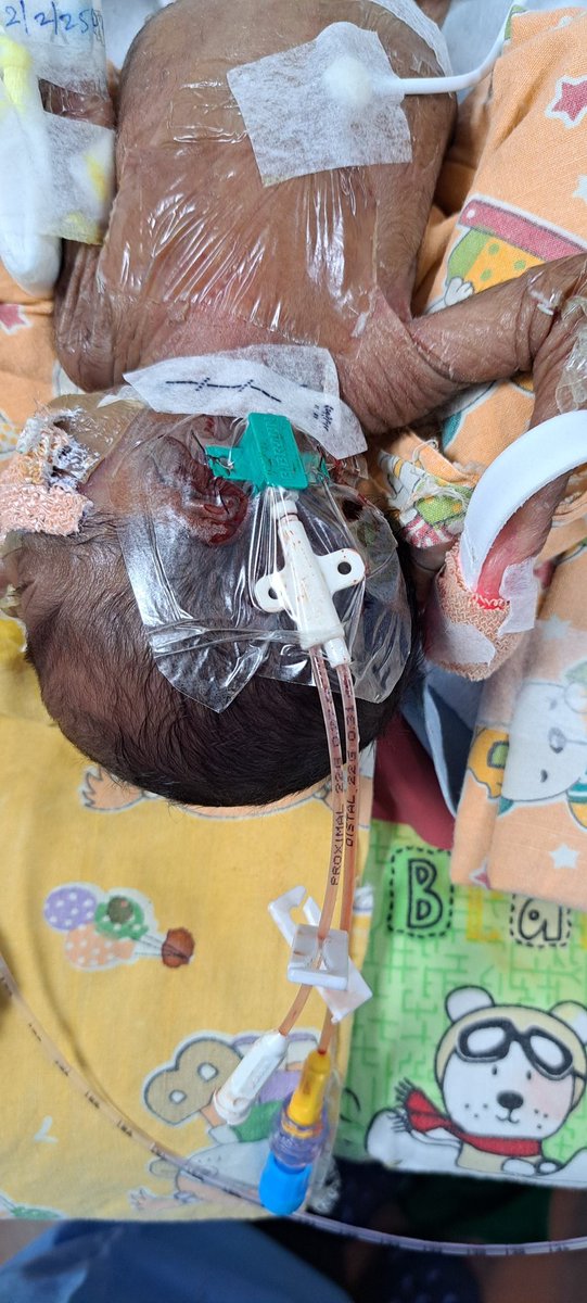 arunkrishnan_b's tweet photo. R IJV , 23 WEEKS 650 GRAMS NNEC https://t.co/JFzeVNKXFy