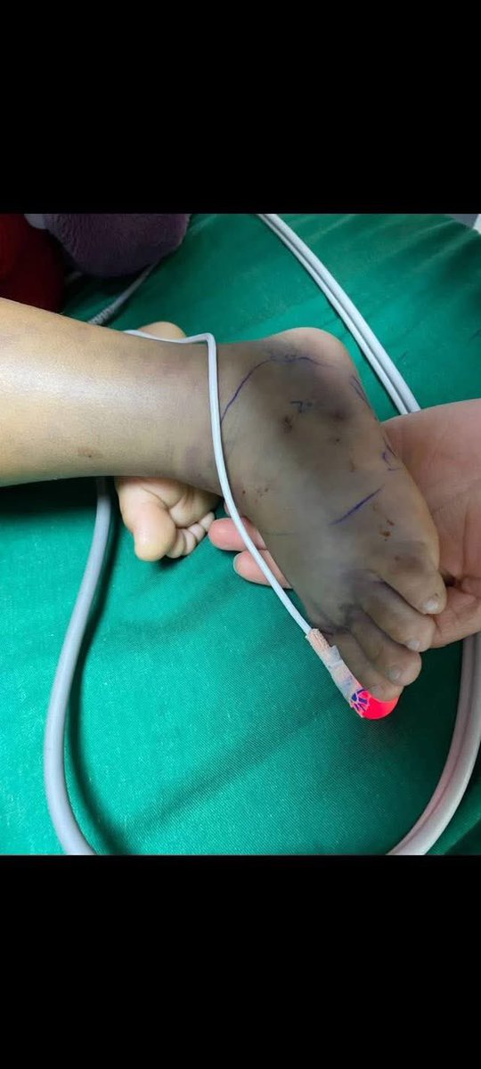 الطّفل علي حسين حمادي (٥ سَنوات)
بحاجه ماسه للدم من فئة AB positive، 
في مستشفى الشيخ راغب حرب، 

تعرض الطفل ليلة امس ل لدغة أفعى فلسطين السامة مما أدى إلى نقله الى مستشفى ( راغب حرب)  لتلقي العلاج، حالته خطيرة جدا.

التّواصل مع جدّه الحاج علي قاسم حمادي٠٣٥٠٨٢٩٩

‼️🚨