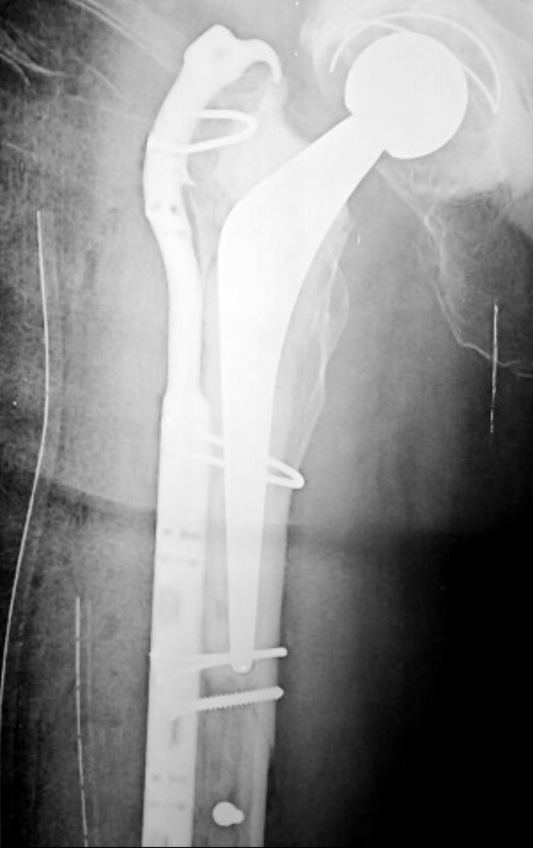 Surgeons sometimes avoid placing screws through the cement mantle during  ORIF of PPFx around a cemented stem due to concerns about stem loosening. 
This study from JBJS (cohort  of 28) shows that  screws through cement doesn't increase loosening.
#orthotwitter