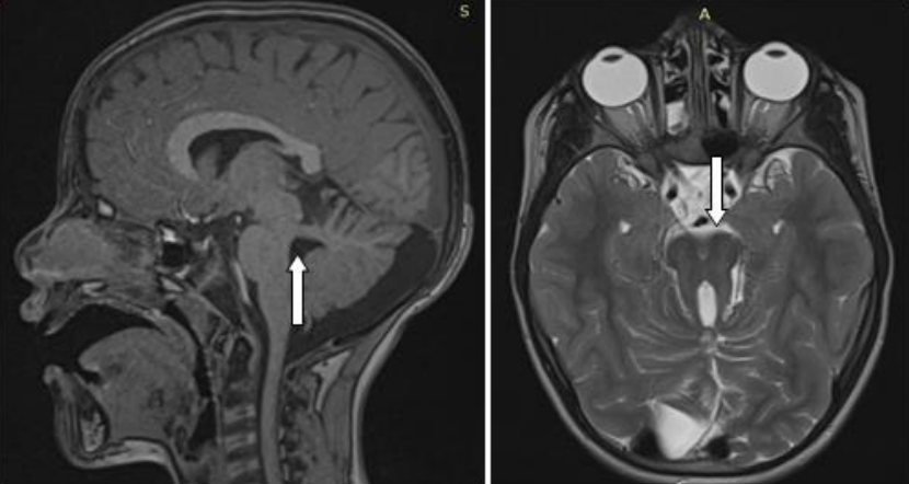 👧7-year-old girl, second-degree consanguinity. History of delayed psychomotor development and hypotonia. Neurological exam confirms motor delay. Brain MRI is performed.

🧑‍⚕️What’s the diagnosis?
