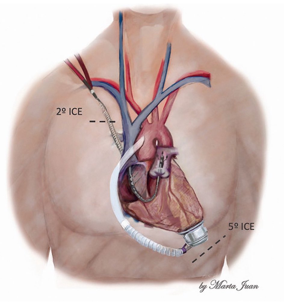 Manuel Perez (@manupegui) on Twitter photo ✨Acceso alternativo para el implante de la cánula Protekduo
🔴 Alternative approach for ProtekDuo cannula implantation
journals.sagepub.com/eprint/RJQTFHB…
<a href="/IC_LaFe/">Insuficiencia Cardiaca y Trasplante</a> <a href="/HospitalLaFe/">HospitalLaFe</a> ✨Acceso alternativo para el implante de la cánula Protekduo
🔴 Alternative approach for ProtekDuo cannula implantation
journals.sagepub.com/eprint/RJQTFHB…
<a href="/IC_LaFe/">Insuficiencia Cardiaca y Trasplante</a> <a href="/HospitalLaFe/">HospitalLaFe</a>