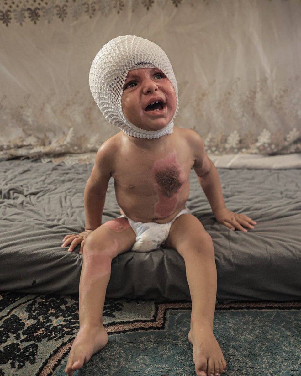 unescozero's tweet photo. İsrail, ağır yaraladığı çocukları abluka ile katlediyor.

1 yaşındaki Muhammed’in vücudu 3. derece yanıklarla kaplı. 2,5 yaşındaki Neccar’ın durumu ise çok ağır, iç organlarında ciddi hasar var.

Acil tedavi edilmezlerse, zulmün karanlığı iki ışığı daha söndürecek.
#Israel https://t.co/59I7UdLdep