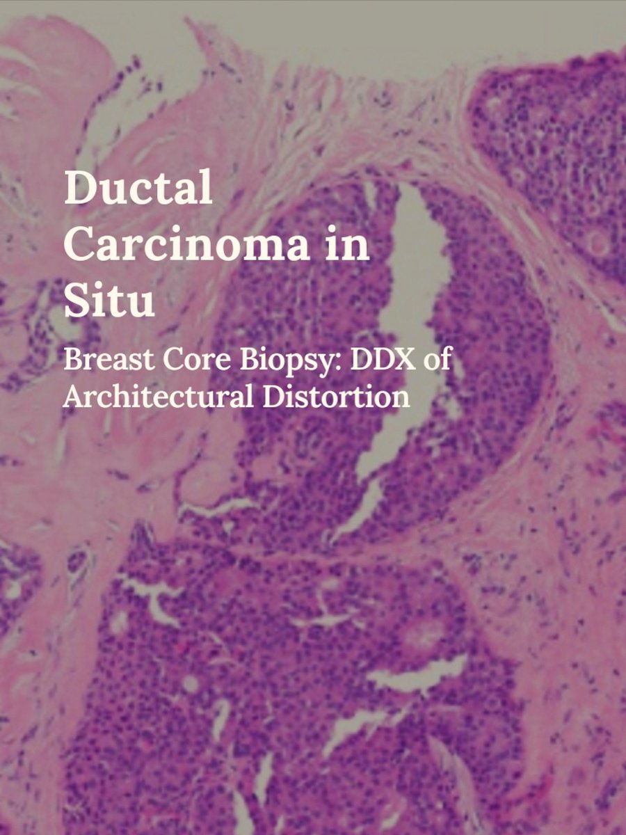 Not your average architectural distortion! Ductal carcinoma in situ can present this way, though more commonly with calcifications.

thepathprincess.substack.com/p/ductal-carci…

A reminder that classic presentations aren't the only ones!💡

#pathology #pathologist #breastpath #pathtwitter #pathX