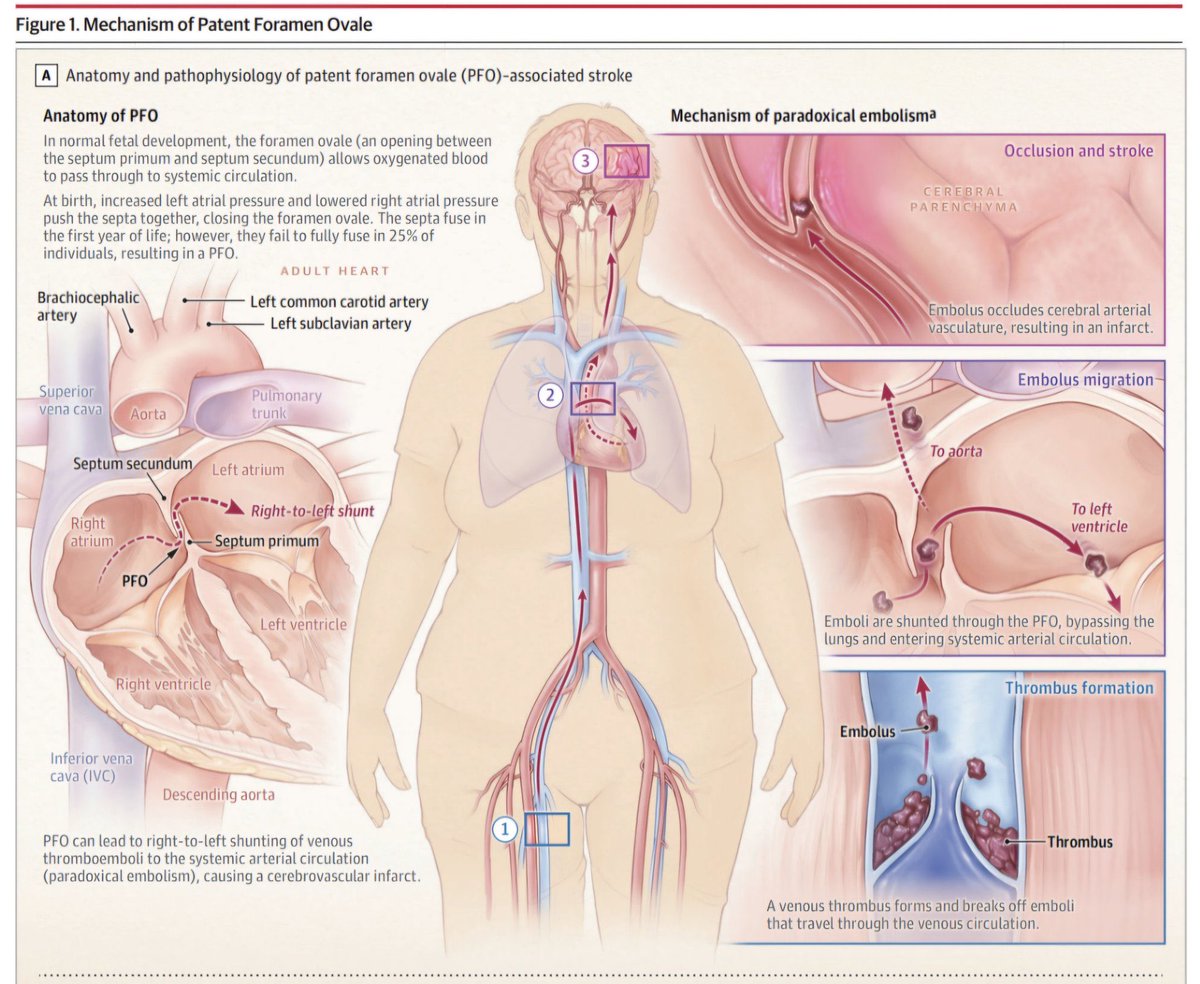 🔴 Patent Foramen Ovale &amp; Stroke <a href="/JAMANetwork/">JAMA Network</a> #Cardiology #Neurology #stroke