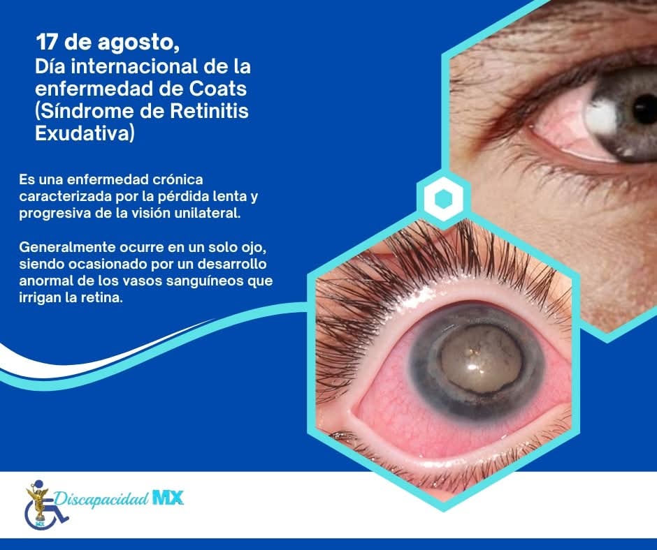 17 de agosto, día internacional de la enfermedad de Coats (Síndrome de Retinitis Exudativa).
facebook.com/share/p/1CStk7…

#DiscapacidadMx #efemerides #Coats