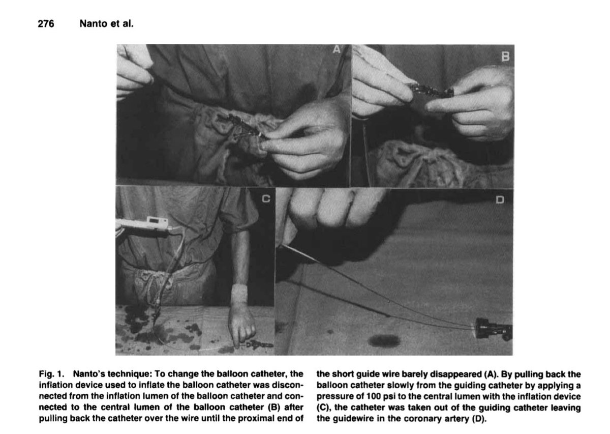 🇯🇵 A Hemodynamics Classic
In 1994, Shinsuke Nanto described an ingenious trick: exchanging over-the-wire balloons using a regular guidewire—no long wire needed.

📖 Cathet Cardiovasc Diagn. 1994;32:274–7.

I truly admire people who come up with ideas that are both simple and