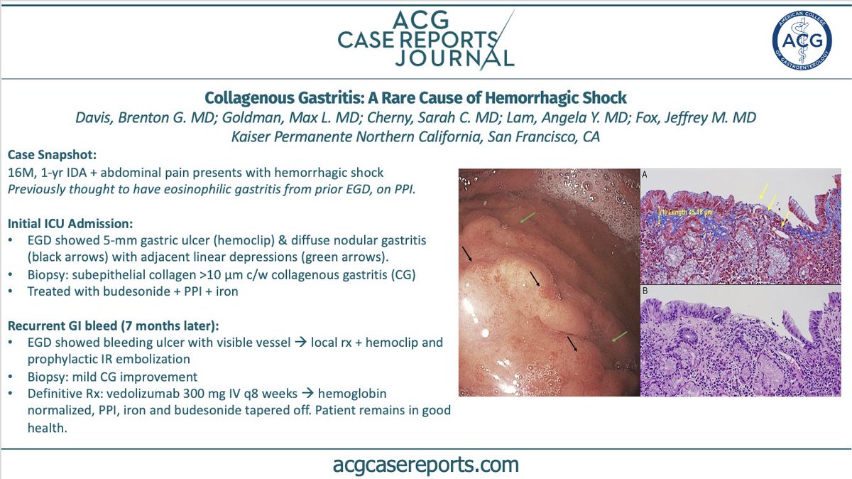 🚨 Editor’s Pick of the Month: 

🚑16M with 1-yr IDA + abd pain → hemorrhagic shock
🧬 Biopsies w special stains → collagenous gastritis!
🩸 First reported pediatric CG with recurrent hemorrhagic shock, ultimate rx → vedolizumab.
🔗 tinyurl.com/3u3d8xpb