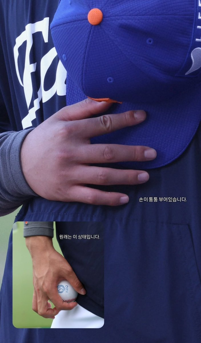 아니 동주 손 너무 부어있는데요??? ㅠㅠ