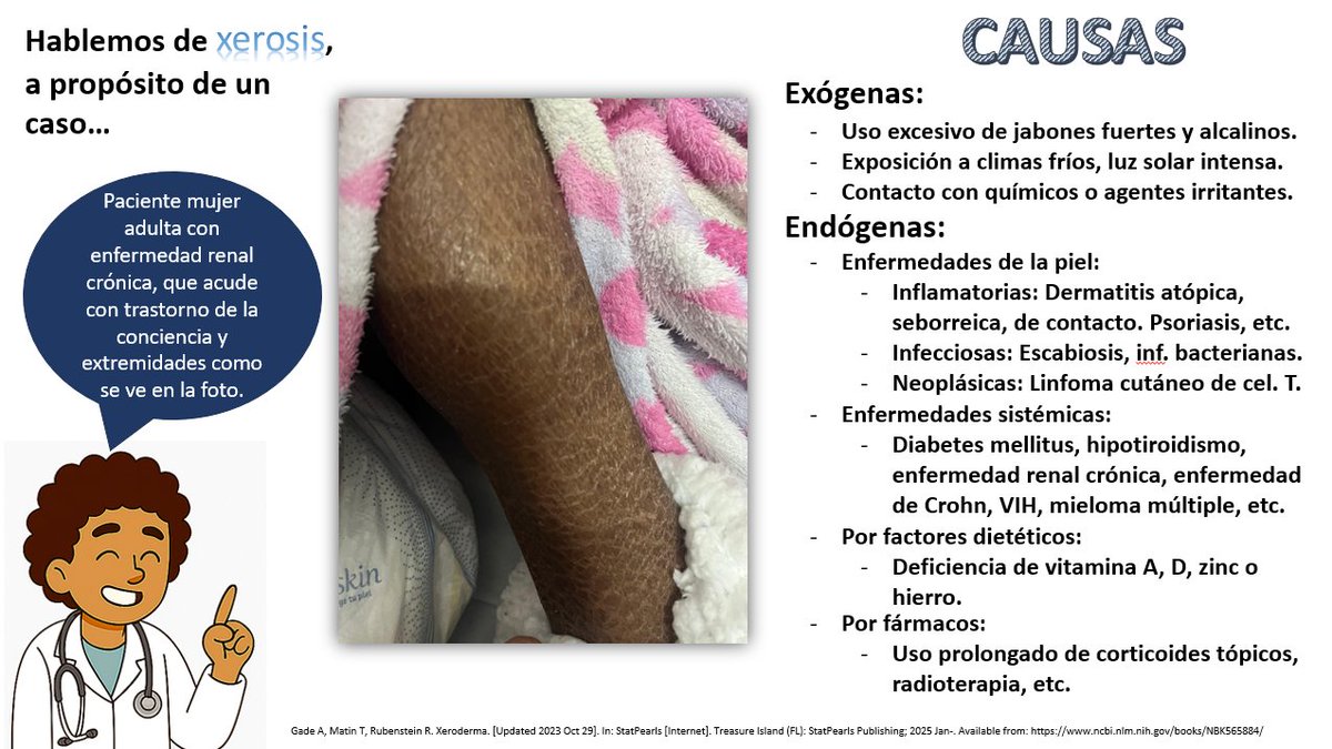 ElOjoInternista's tweet photo. A propósito de un caso visto en emergencias, repasemos las causas de xerosis (piel seca) y su correlación con algunas enfermedades sistémicas complejas. 
#MedicinaInterna #InternalMedicine
#Semiología #Semiology
#Xerosis #fyi 
#ElOjoInternista
#Emergencias #Emergency https://t.co/ty9h0lCGhA