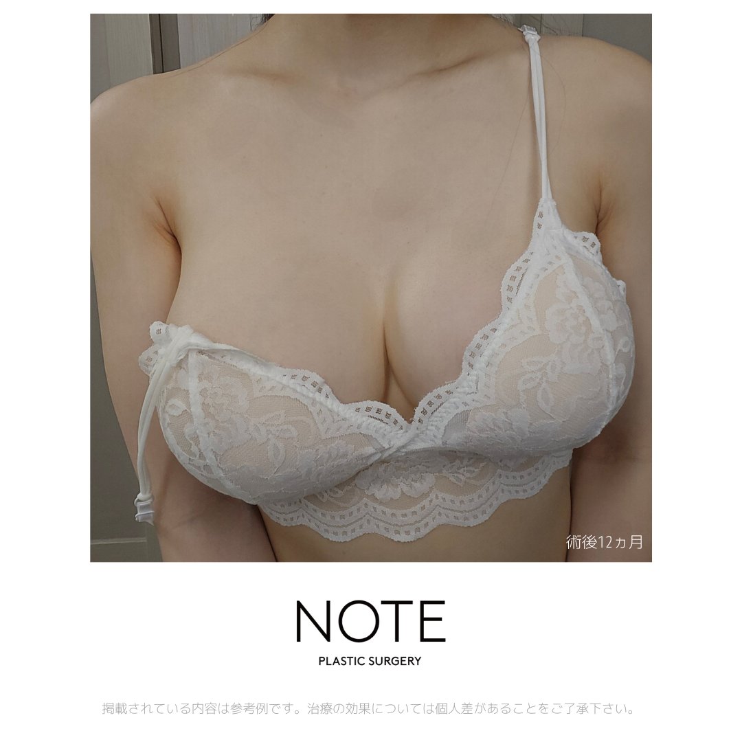 noteps_jp's tweet photo. 「とにかくしっかりボリュームがほしい」「不自然にならないようにラインにもこだわりたい」

そんなご要望に合わせて、モティバ・フルタイプで最大限のサイズ感を実現しました

👨‍⚕️クォン代表院長
💉 モティバ・フル　右: 400cc  左: 425cc/ デュアルプレーン法
⁡📍 156cm / 50kg

柔らかさ・丸み・揺れ感・ハリ感すべてにこだわったデザイン。 
クォン・スングン院長に出会えば流行に左右されない洗練された仕上がりを手に入れることができるでしょう✨

ぜひ公式LINEからお気軽にご相談くださいませ💌 https://t.co/JK9vhNJD04

豊胸専門医クォン代表院長の紹介動画もチェック！ https://t.co/lEfqMikIDL