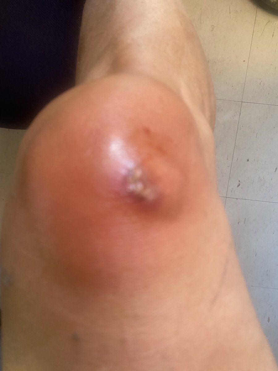 Bad Bike!
Asshole Car (Driver)!
Really Beaten Up Knee!
CHEERS!