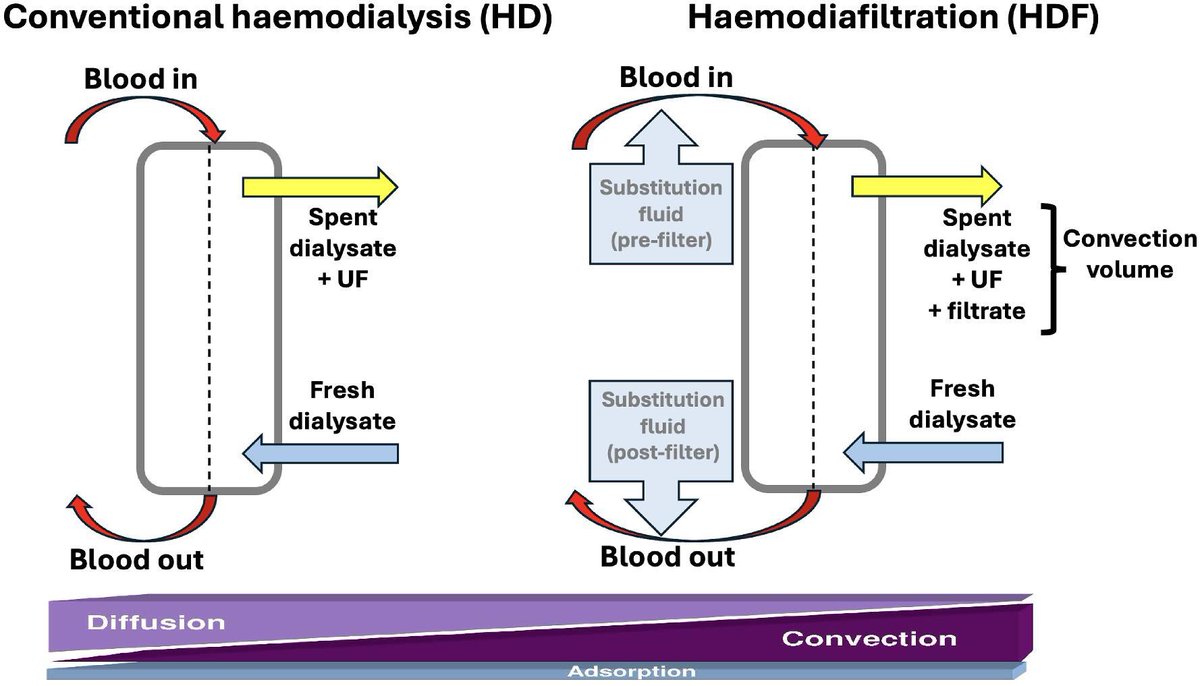 hardik4u24's tweet image. 🔄💉#HD vs #HDF: not just acronyms, but different clearance mechanisms!

🧪Diffusion rules #Haemodialysis,
Convection drives #Haemodiafiltration

📊ERA–EuDial Consensus:HDF clears more middle molecules &amp;amp; may offer clinical edge

🔗doi.org/10.1093/ndt/gf…

#Nephrology #Dialysis