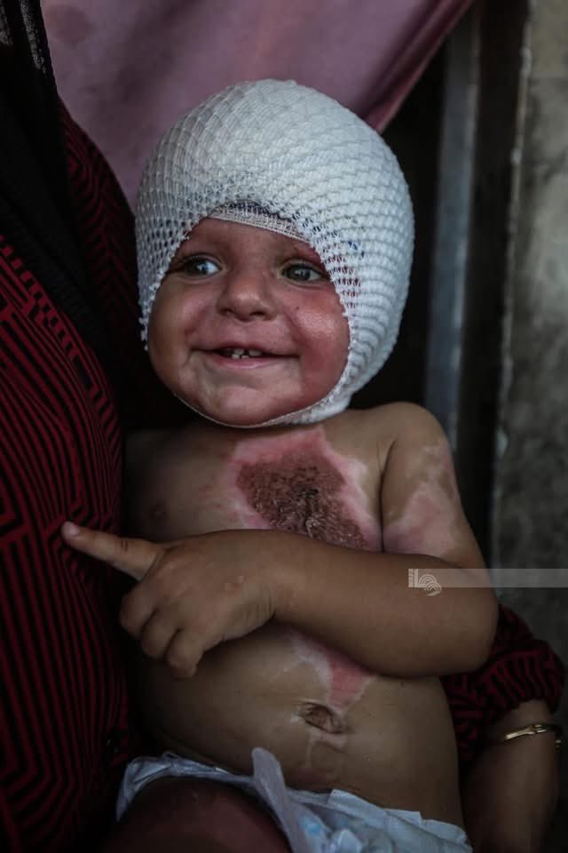 help_m7ammed23's tweet image. 💔💔💔  Gaza 🇵🇸This little child, named Mohammed Hajila, is only one year old, was injured and serious burns by the occupation missiles and needs treatment as soon as possible💔🇵🇸