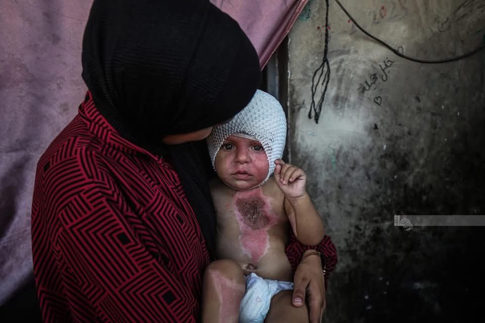 help_m7ammed23's tweet image. 💔💔💔  Gaza 🇵🇸This little child, named Mohammed Hajila, is only one year old, was injured and serious burns by the occupation missiles and needs treatment as soon as possible 💔🇵🇸🥹