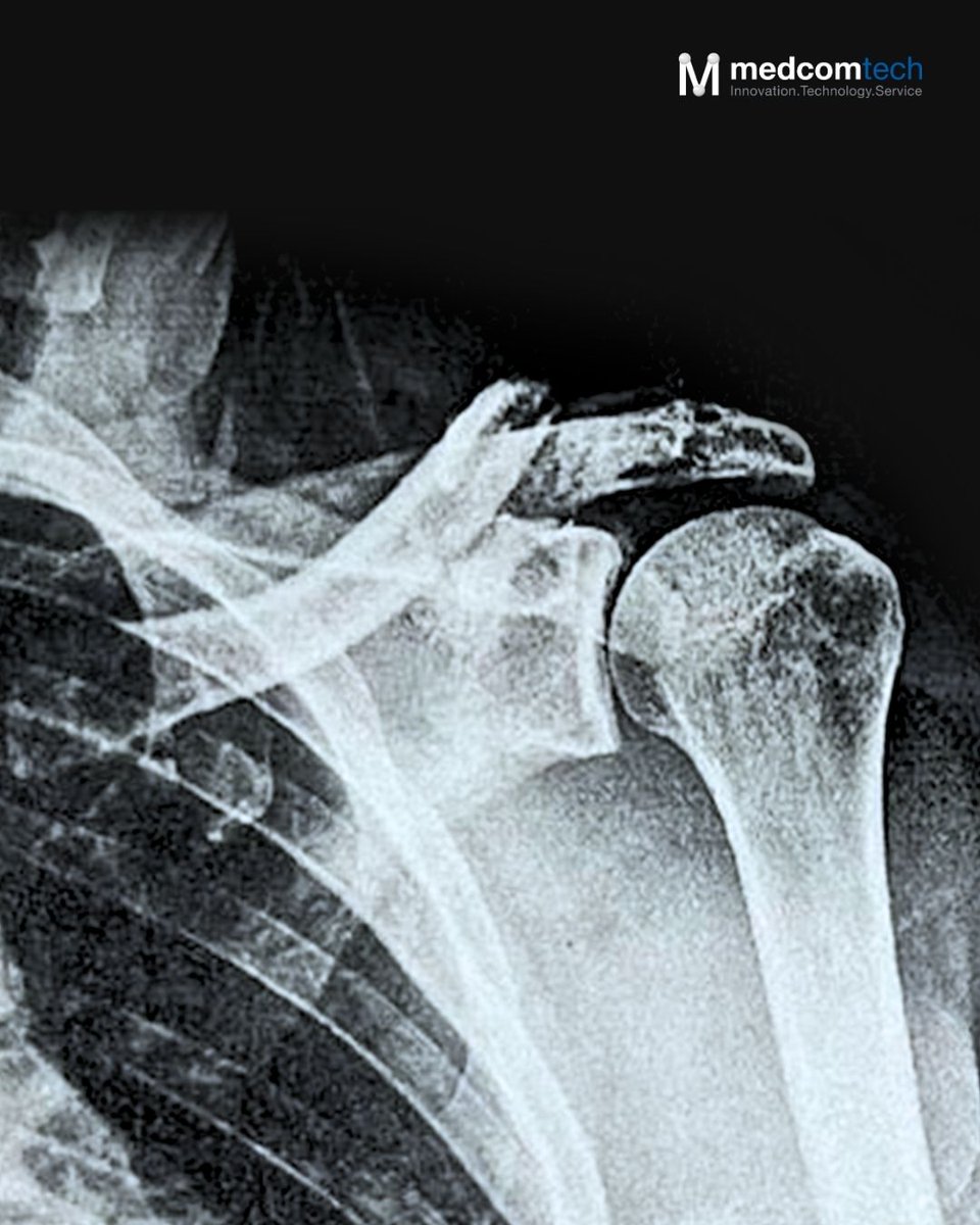 medcomtech_sa's tweet photo. Primera implantación de la placa de clavícula Hofer en la Unidad de Traumatología Deportiva del Hospital de Martorell, realizada por los Dres. Triguero y Vallejo. Innovación aplicada a la recuperación de pacientes con fractura de clavícula.
#medcomtech #siempreconlosmedicos https://t.co/fGOXJsmskD