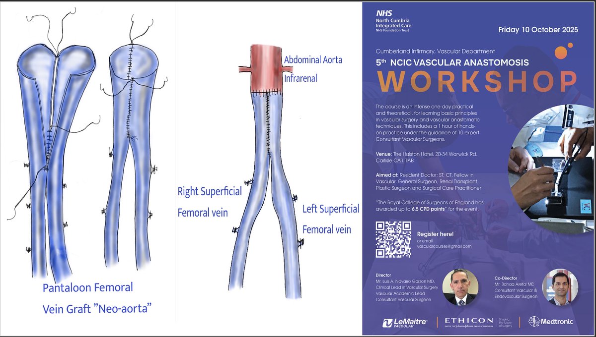 Do you want to learn how to perform a Pantaloon Vein graft, Neo Aorta? Register now for our course and in a friendly, stress-free environment you can learn this and much more. We have spots available. Scan the QR code to register. We are waiting for you. <a href="/RouleauxClub/">Rouleaux Club</a> <a href="/SudavasSd/">Sudanese Association of vascular surgeons</a>