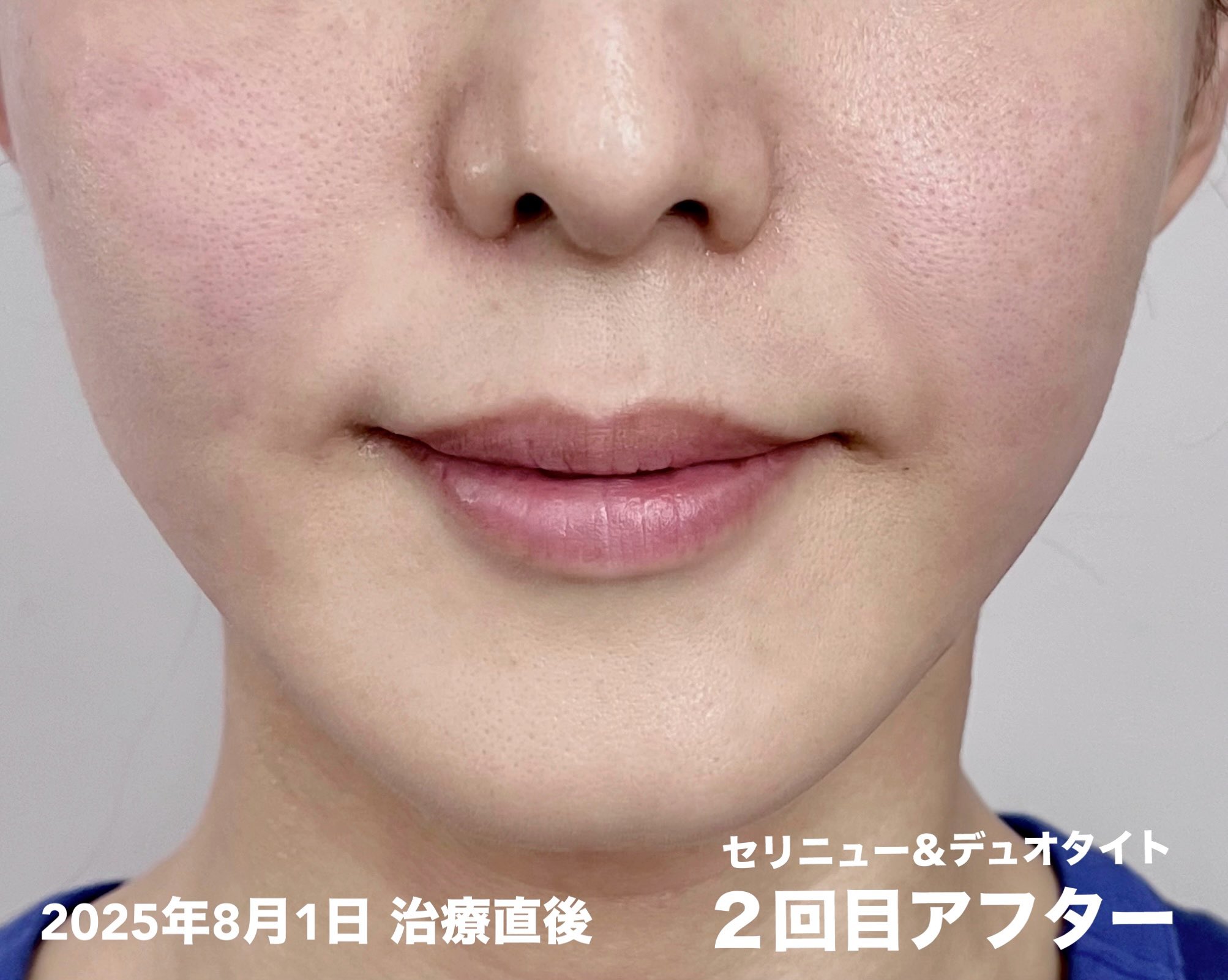 フェイスクリーム miyukidaifuku2 北海道牛乳 フェイスクリーム 50g(顔 保湿クリーム フェイス