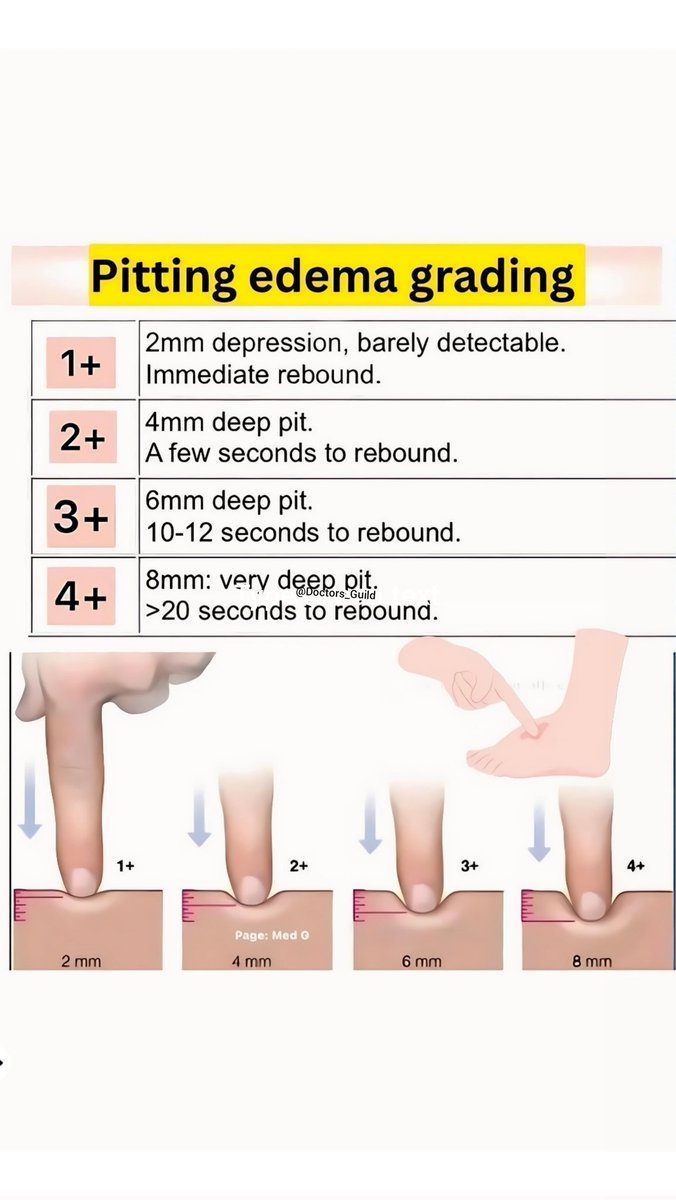 Grading of pitting edema