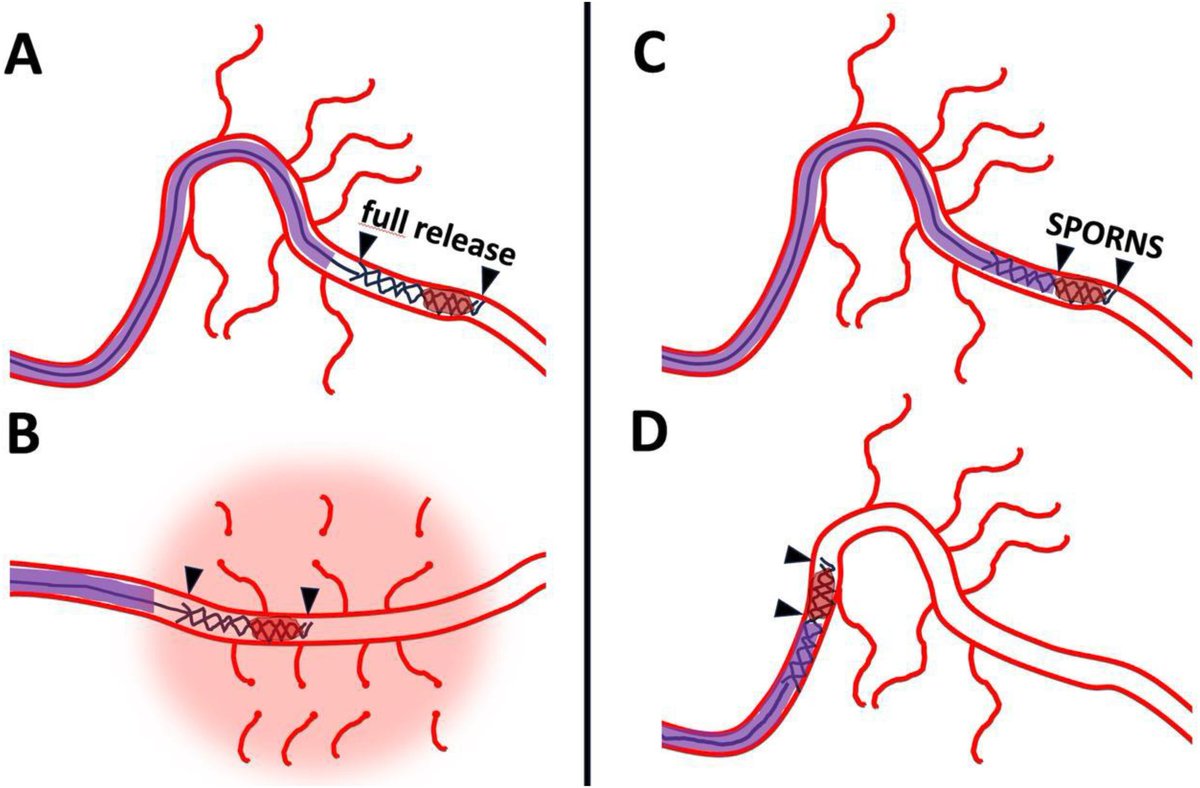 NANConsortium's tweet image. Why EVT failed to demonstrate benefit in DMVO trials?

@PSporns @WFITN_Society
#INR #DMVO #Thrombectomy
See more:journals.sagepub.com/doi/10.1177/15…