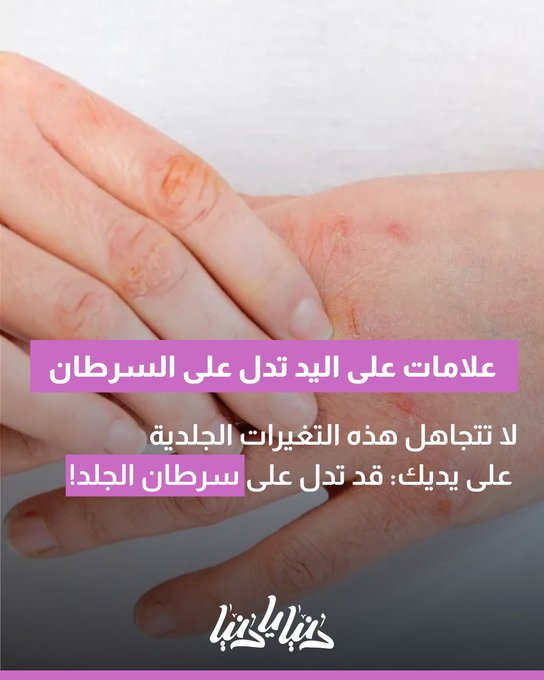 لا تتجاهل هذه التغيرات الجلدية على يديك: قد تدل على سرطان الجلد 
