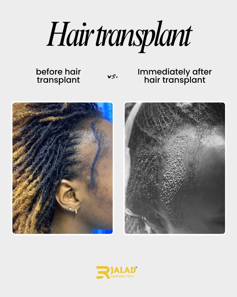 Transplants aren’t just about moving hair they’re about restoring density strategically. Ever wonder how we decide graft placement? It’s based on your natural pattern, hair texture, and future loss projection.