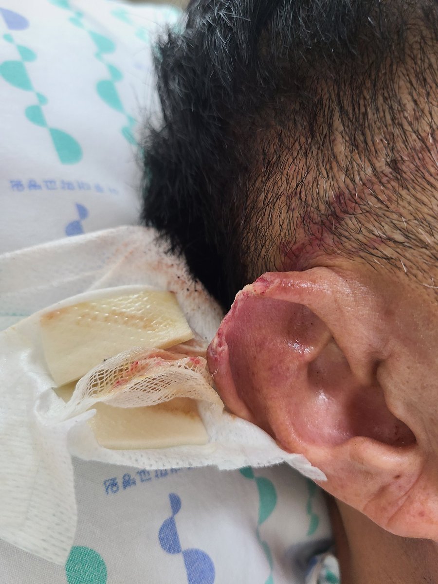 아부지 귀 뜯긴 사진 첨부합니다. 
얼굴도 심각한데 그건 차마 못올리겠어서 이 사진이라도 올려둡니다.