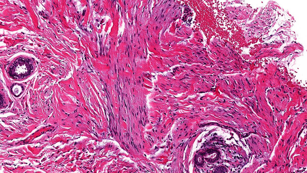 Let’s review the tricky differential of low-grade spindle cell lesions of the breast this week!

Case of Pseudoangiomatous Stromal Hyperplasia (PASH) 🔬

Usually mimicking vessels, PASH can also appear fascicular.

#PathX #PathTwitter #breastpath