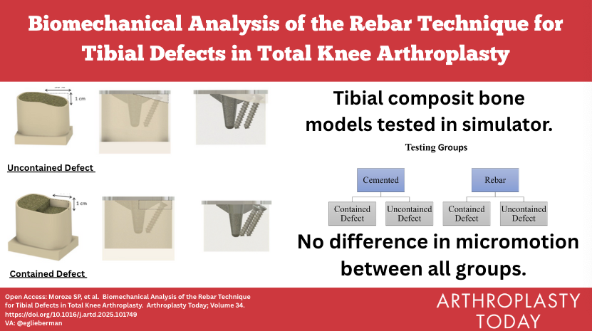 Arthroplasty Today (@arthrotoday) on Twitter photo In this study cement + screws did not improve stiffness and micromotion vs cement alone in tibial bone defects.
How do you mind the gaps? <a href="/FL_Ortho/">Florida Orthopaedic Institute</a> <a href="/wesmayes12/">Wes Mayes</a> <a href="/hugortopedista/">Hugo Rodríguez, MD</a>
arthroplastytoday.org/article/S2352-…
VA: <a href="/eglieberman/">Lizzie Lieberman MD</a> In this study cement + screws did not improve stiffness and micromotion vs cement alone in tibial bone defects.
How do you mind the gaps? <a href="/FL_Ortho/">Florida Orthopaedic Institute</a> <a href="/wesmayes12/">Wes Mayes</a> <a href="/hugortopedista/">Hugo Rodríguez, MD</a>
arthroplastytoday.org/article/S2352-…
VA: <a href="/eglieberman/">Lizzie Lieberman MD</a>