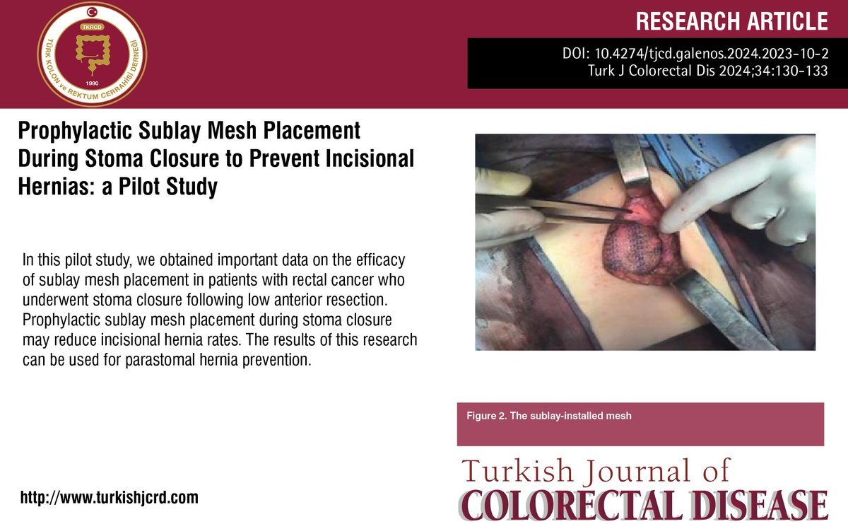 turkdiscolrect's tweet photo. Prophylactic Sublay Mesh Placement During Stoma Closure to Prevent Incisional Hernias: a Pilot Study
You can see the free full text of the research by Yana Belenkaya et al.
Link : https://t.co/ExDdgEzeIH
#Hernia #stoma #closure #sublay #mesh #rectal #cance https://t.co/rgAe45ymMw